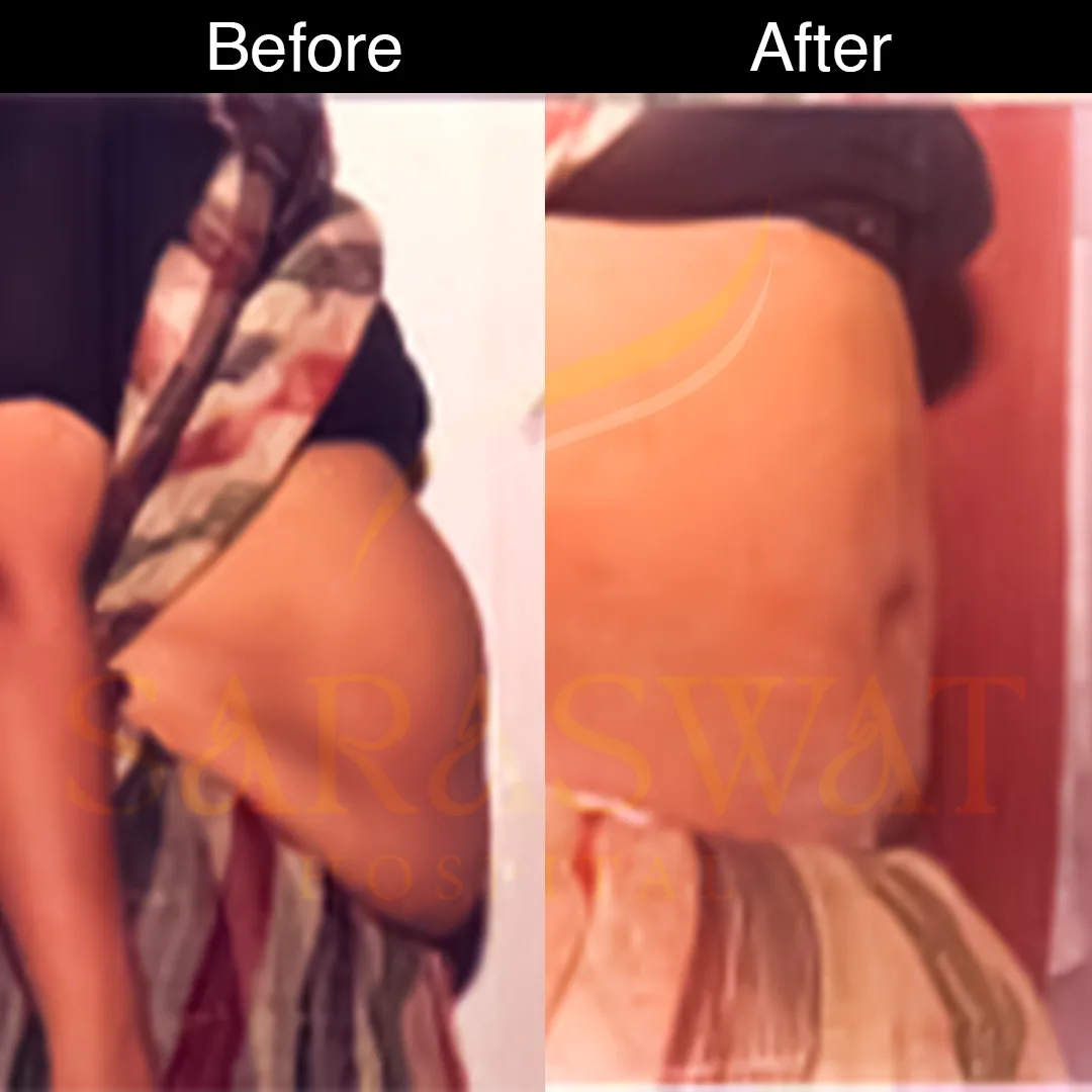 Liposuction Surgery in India