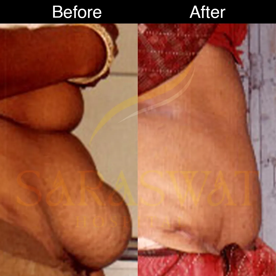 Liposuction Before and After