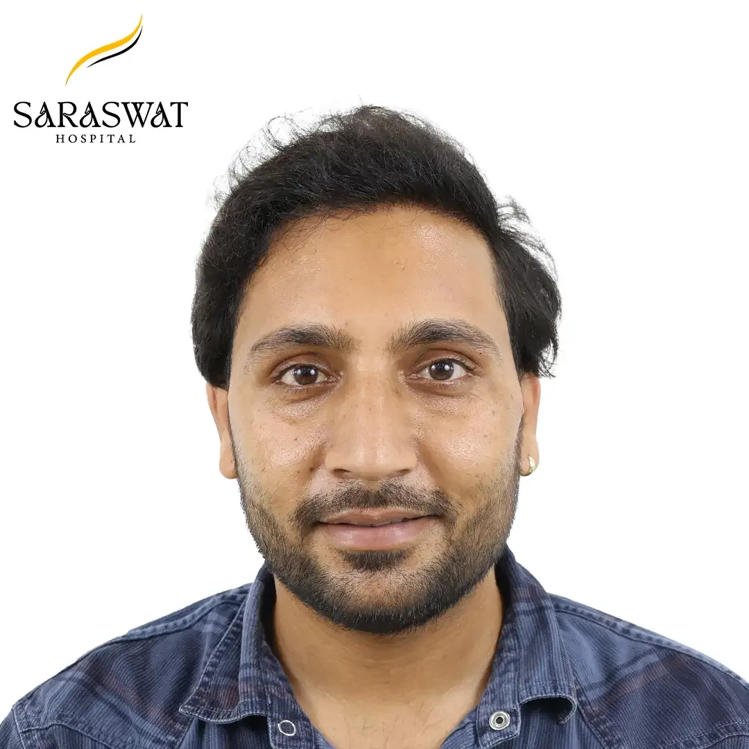 Front FUE Hair Transplant Result After Procedure
