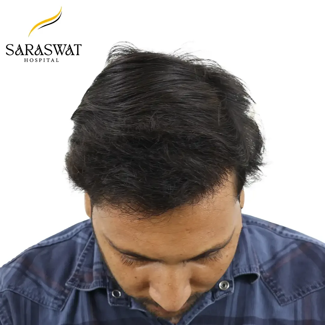 Hair Transplant Cost in India