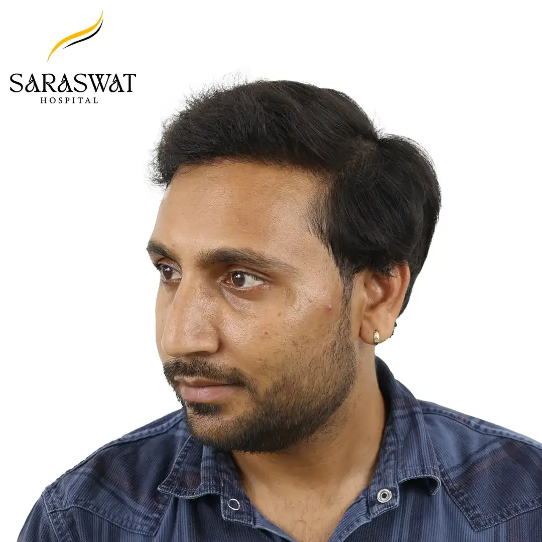 Hair Transplant Cost