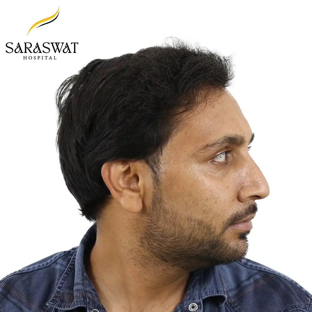 Hair Transplant Near me