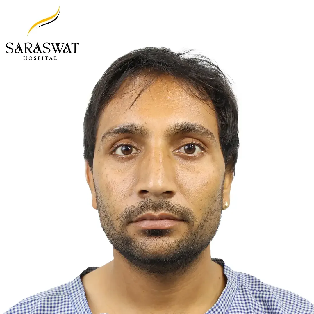 Front FUE Hair Transplant Result Before Procedure