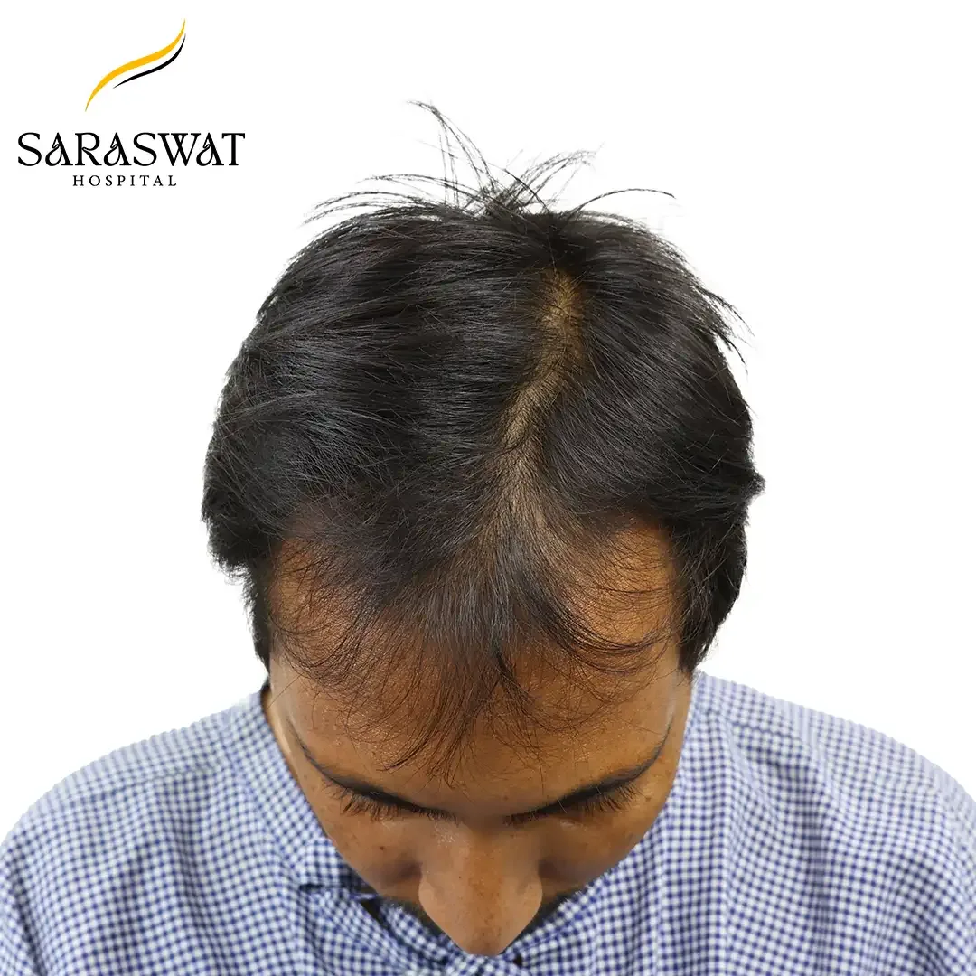 Hair Transplant Cost in India