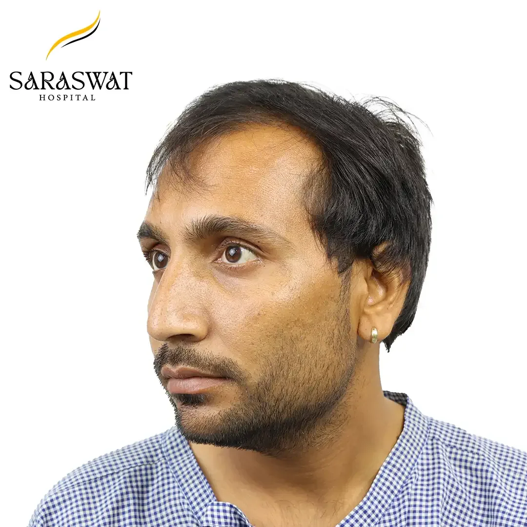 Hair Transplant Cost