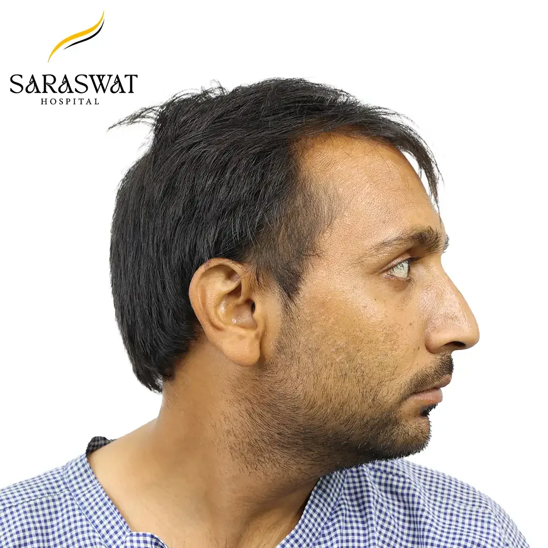 Hair Transplant Near me