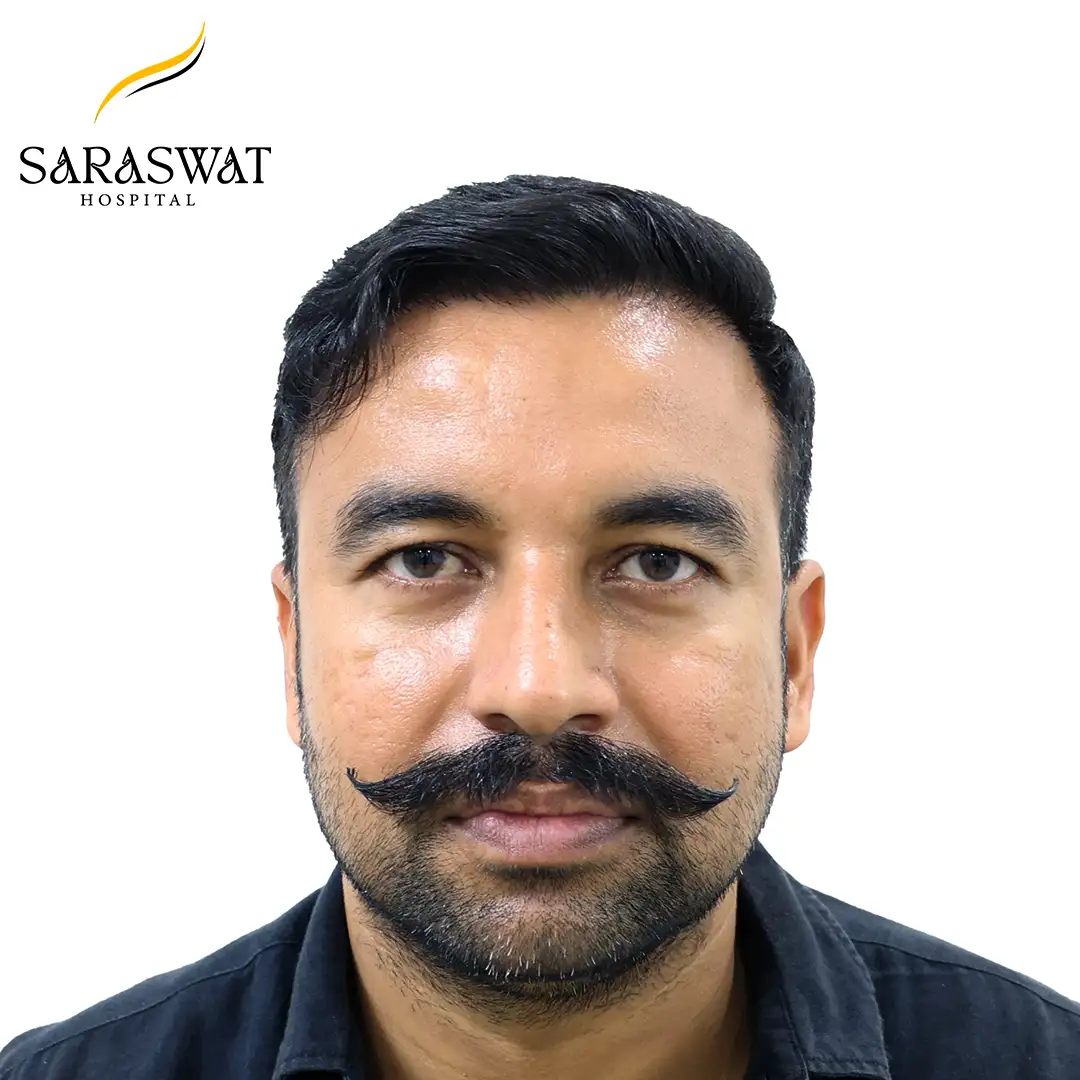 Front FUE Hair Transplant Result After Procedure