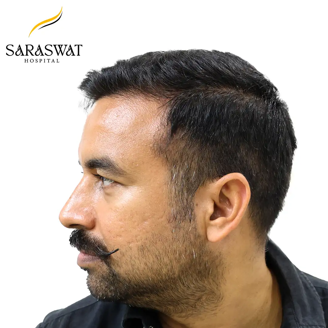 Hair Transplant Before and After