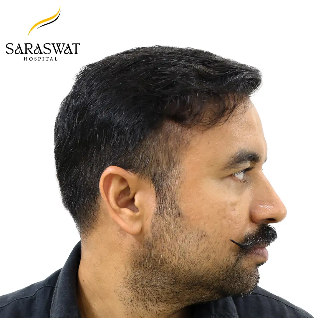 FUE Hair Transplant