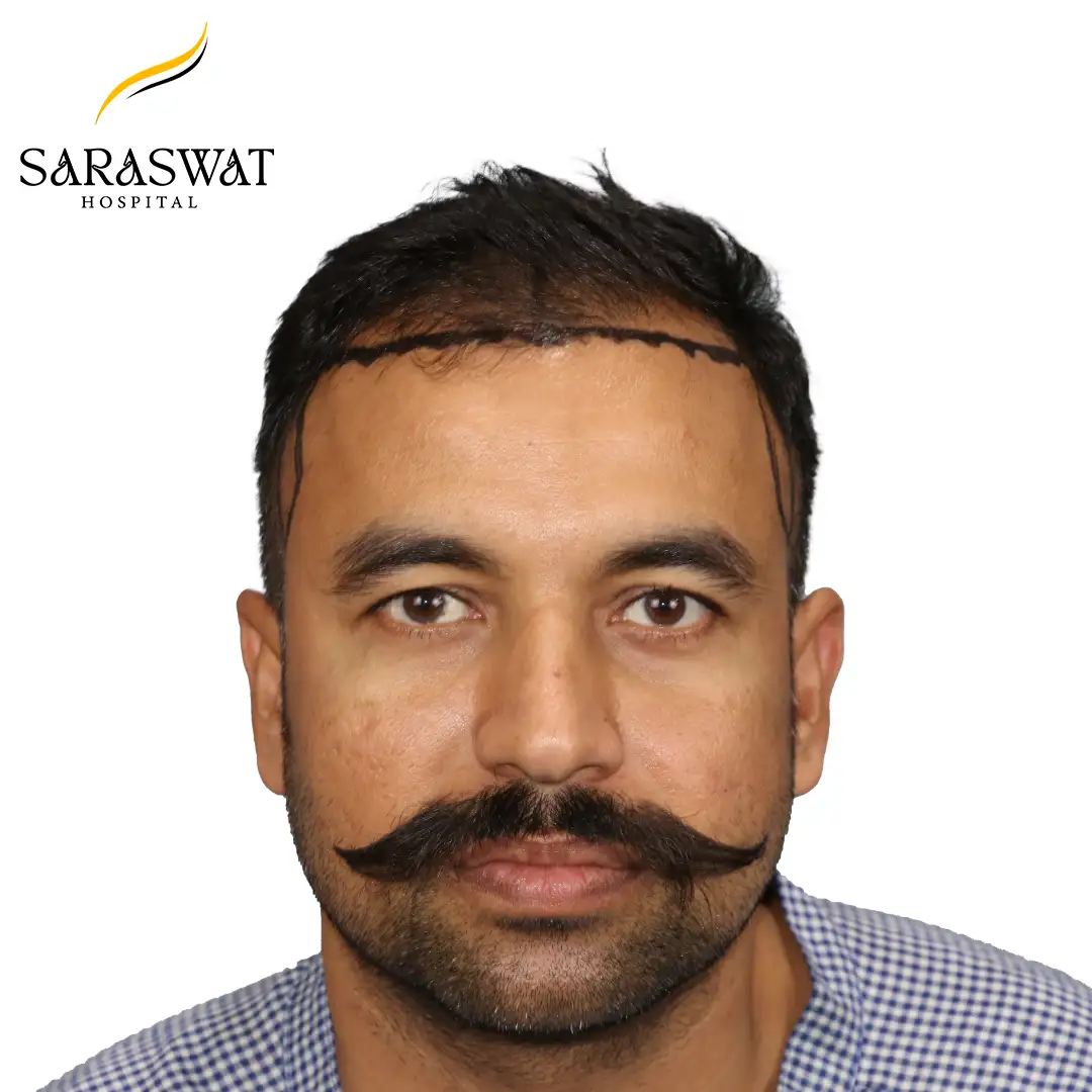 Front FUE Hair Transplant Result Before Procedure