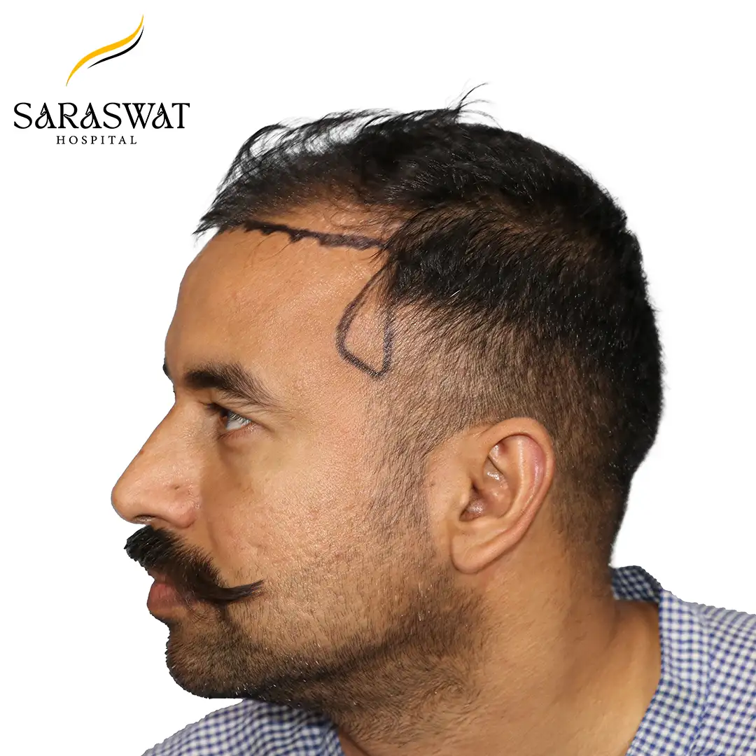 90 Degree Left FUE Hair Transplant Result Before Procedure