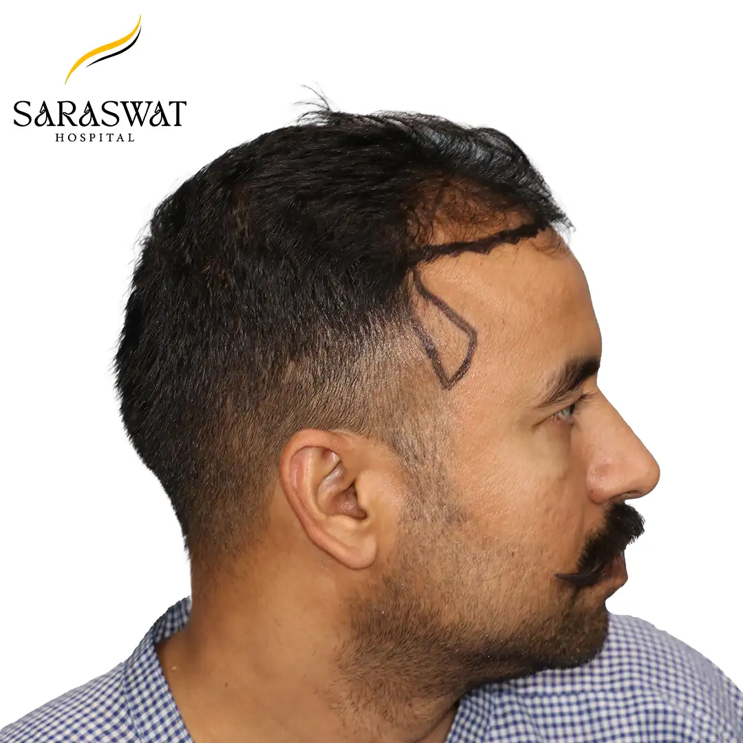 90 Degree Right FUE Hair Transplant Result Before Procedure