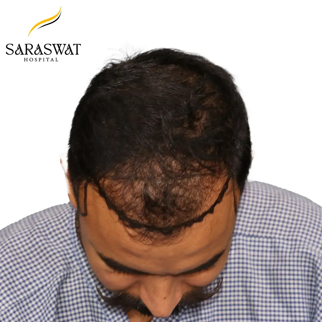Top FUE Hair Transplant Result Before Procedure