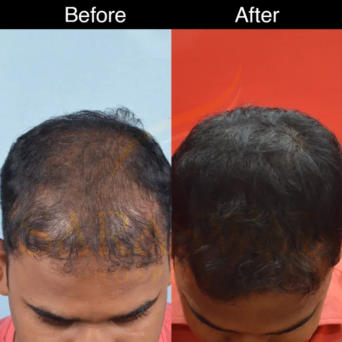Mesotherapy Hair Results