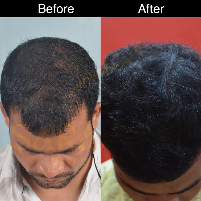 Mesotherapy Hair Results