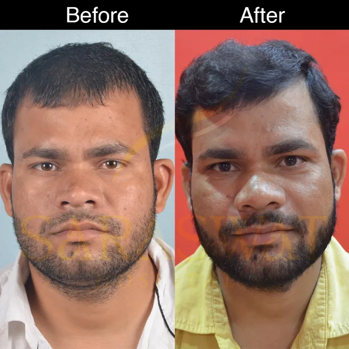 Mesotherapy Hair Results