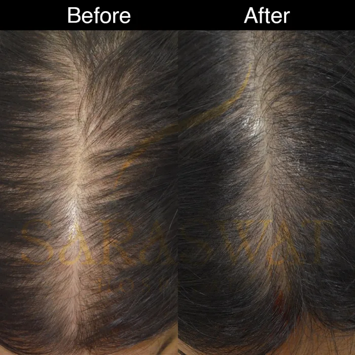 Mesotherapy Hair Results