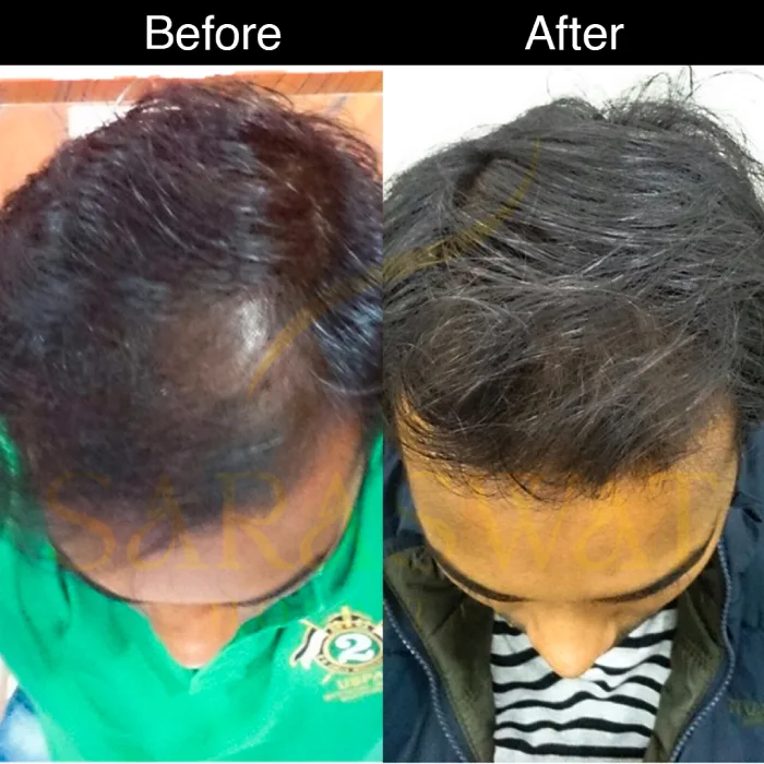 Mesotherapy Hair Results