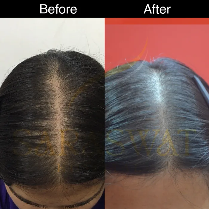 Mesotherapy Results