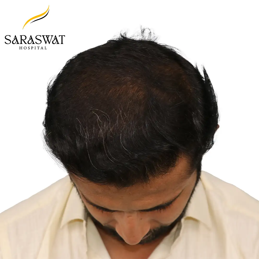 Best Hair Transplant Clinic in India