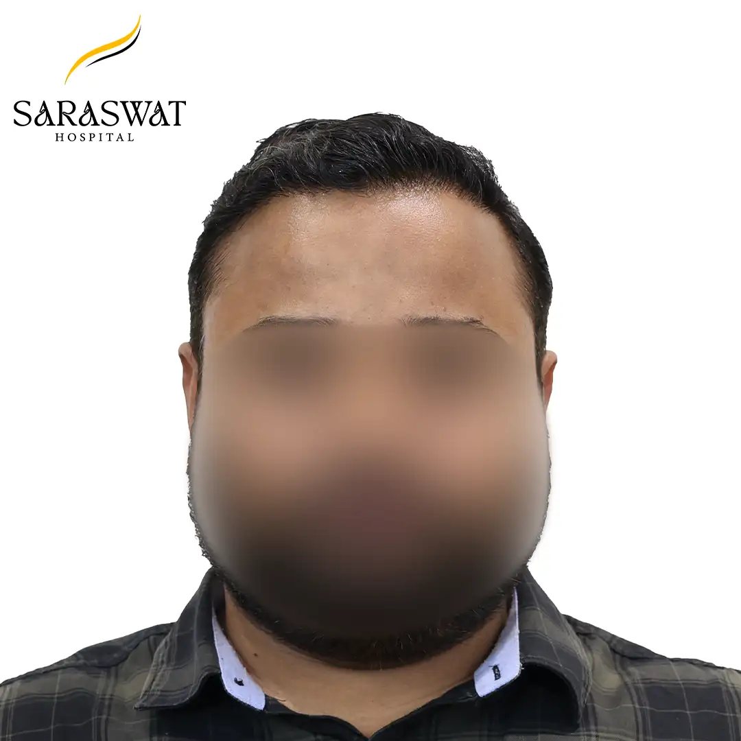 Hair Transplant Before and After