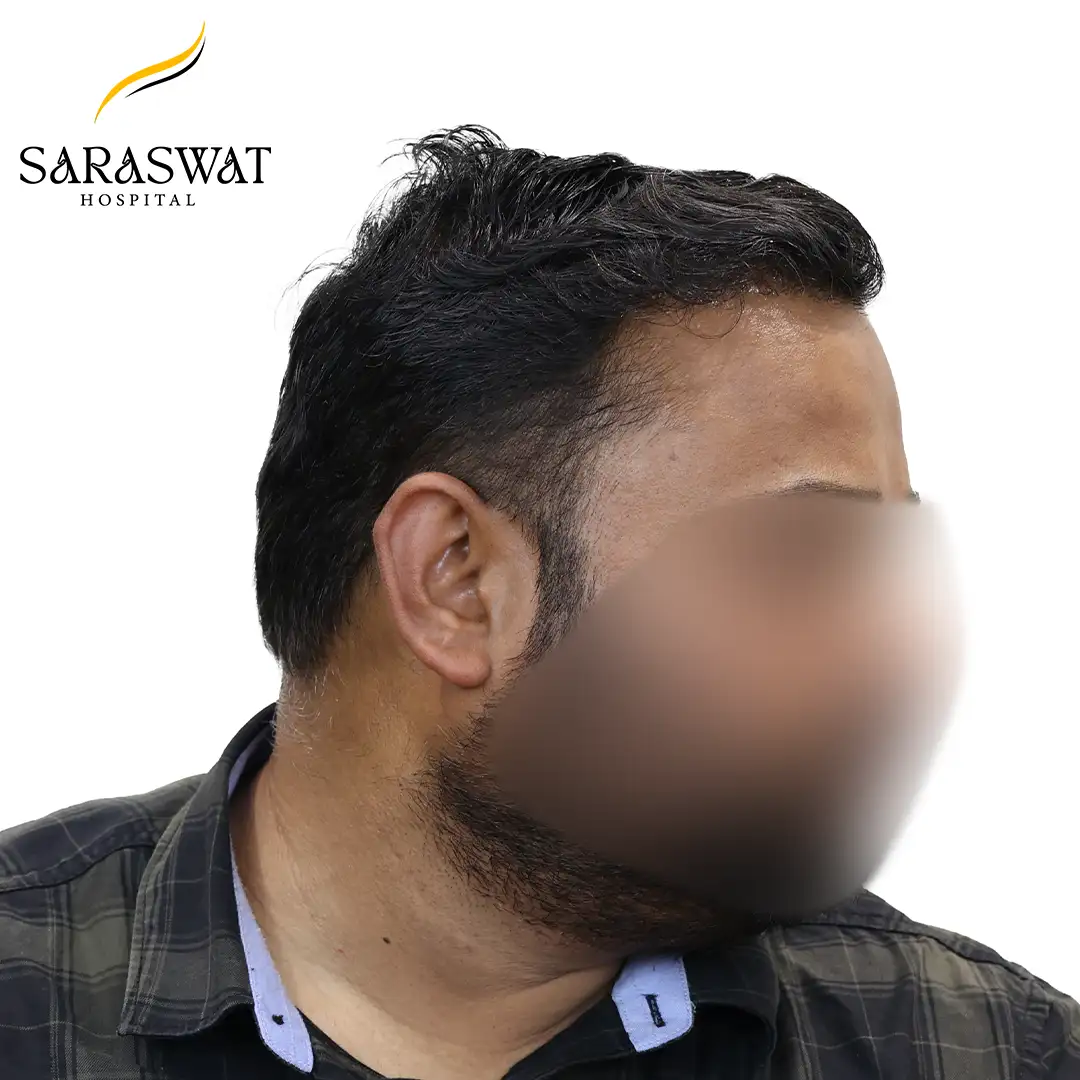 Hair Transplant Before and After