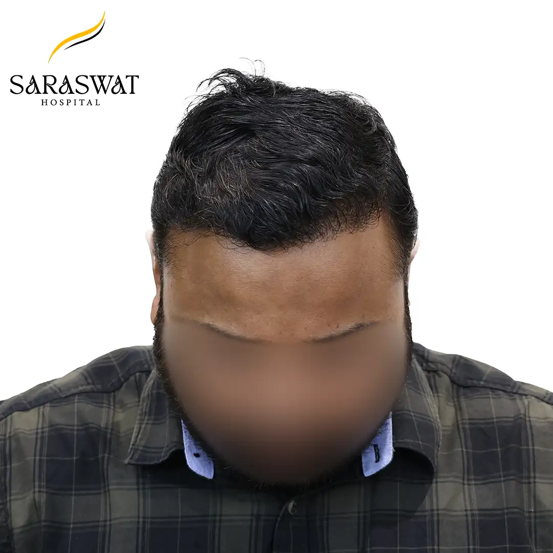 Hair Transplant Before and After
