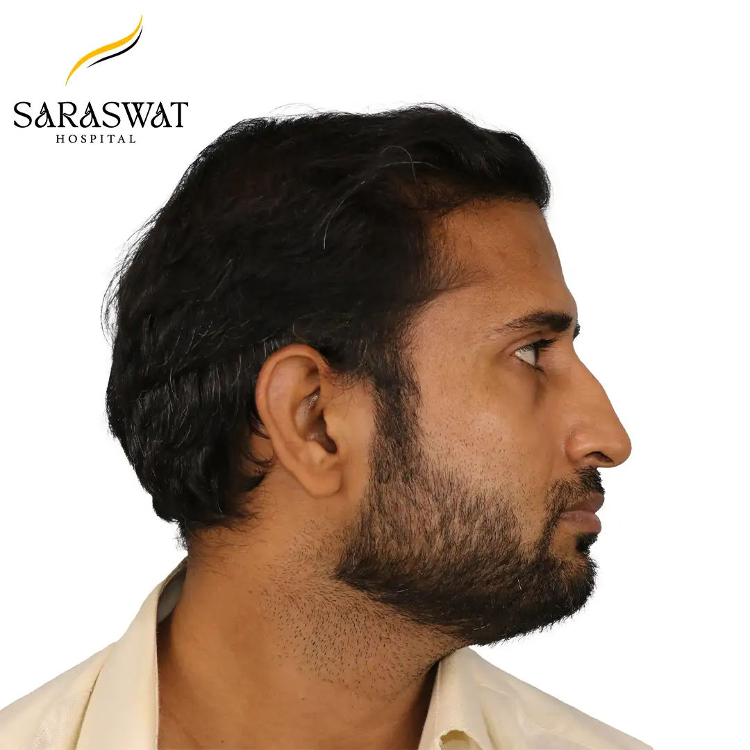Best Hair Transplant Clinic in India | Saraswat Hospital