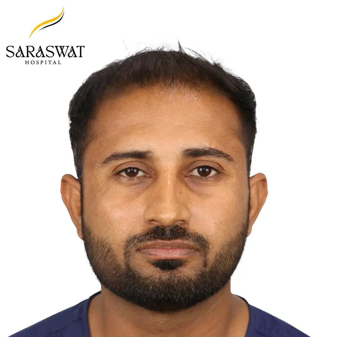 Hair Transplant Cost in India