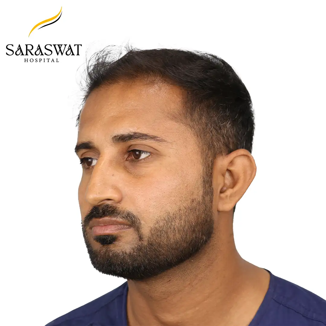 Best Hair Transplant Clinic in India