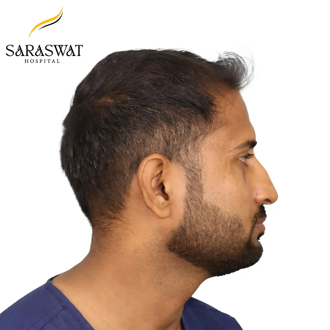 Best Hair Transplant Clinic in India | Saraswat Hospital