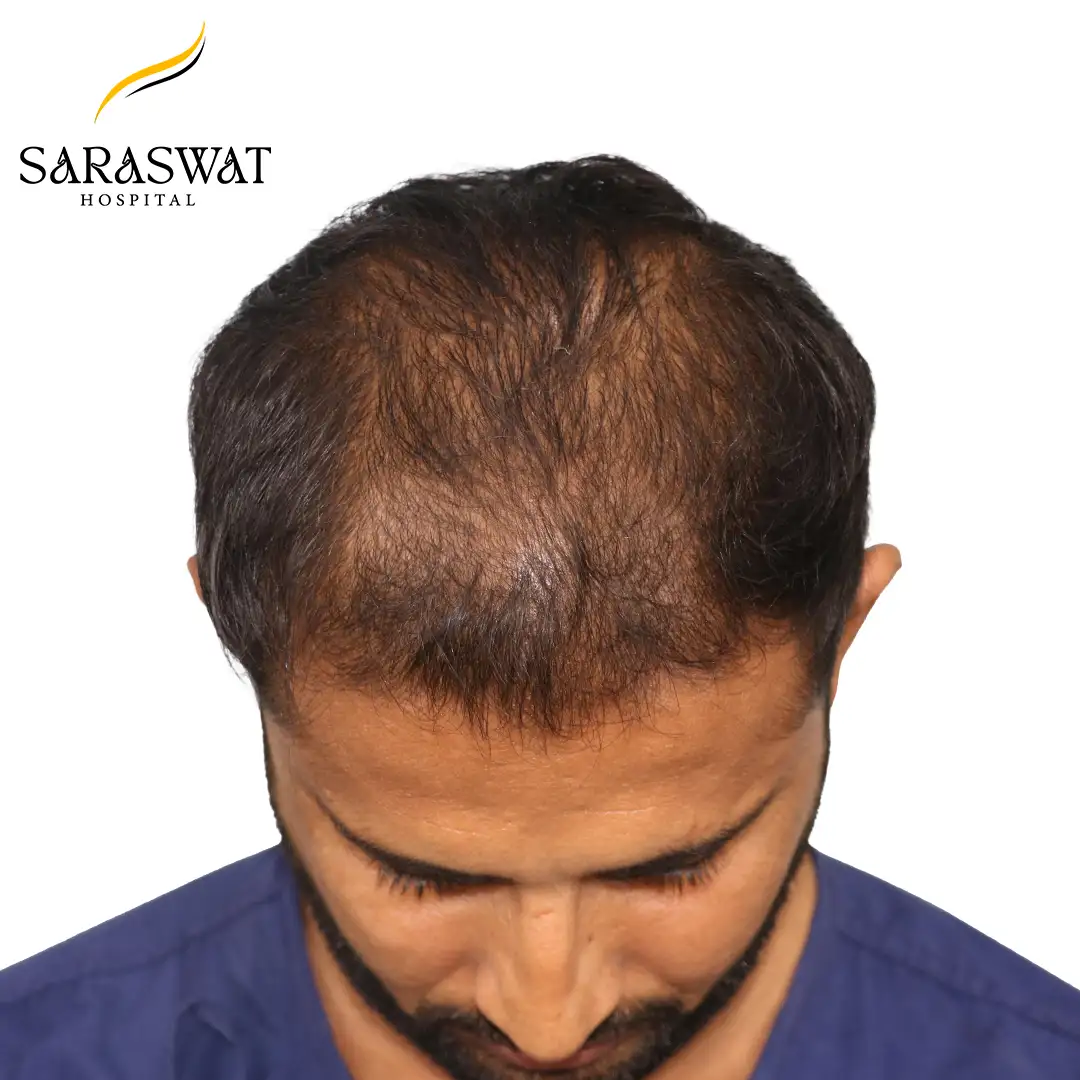 Best Hair Transplant Clinic in India