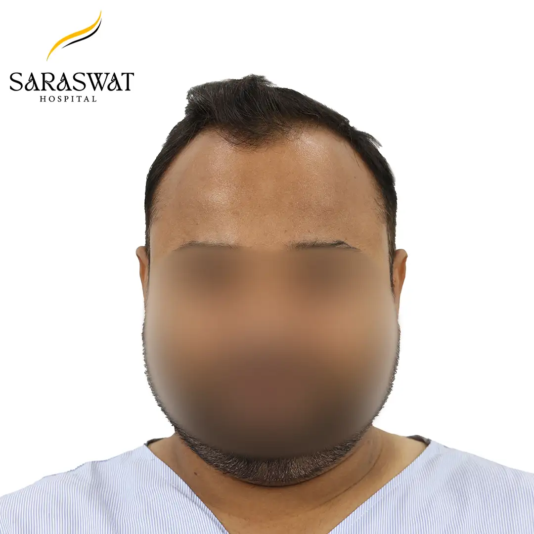 Hair Transplant Before and After