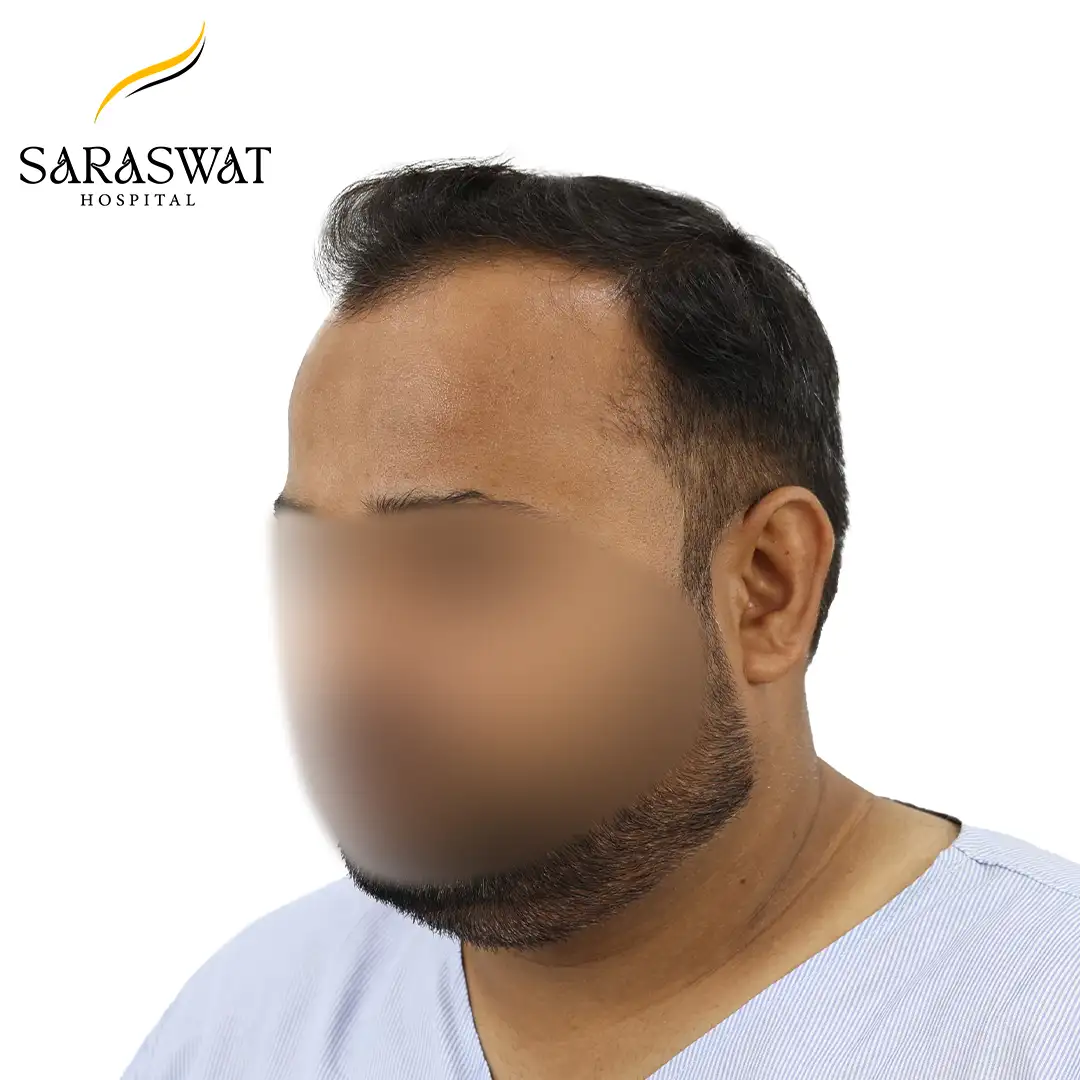 Hair Transplant Before and After