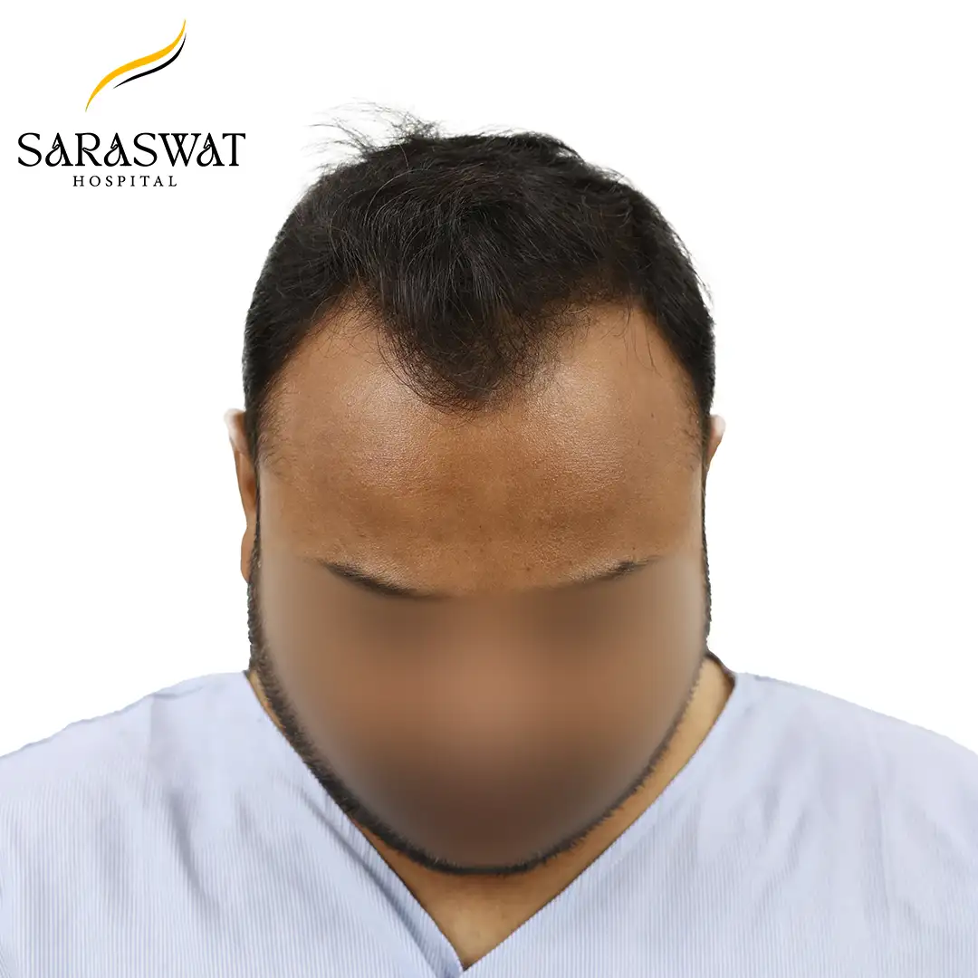 Hair Transplant Before and After
