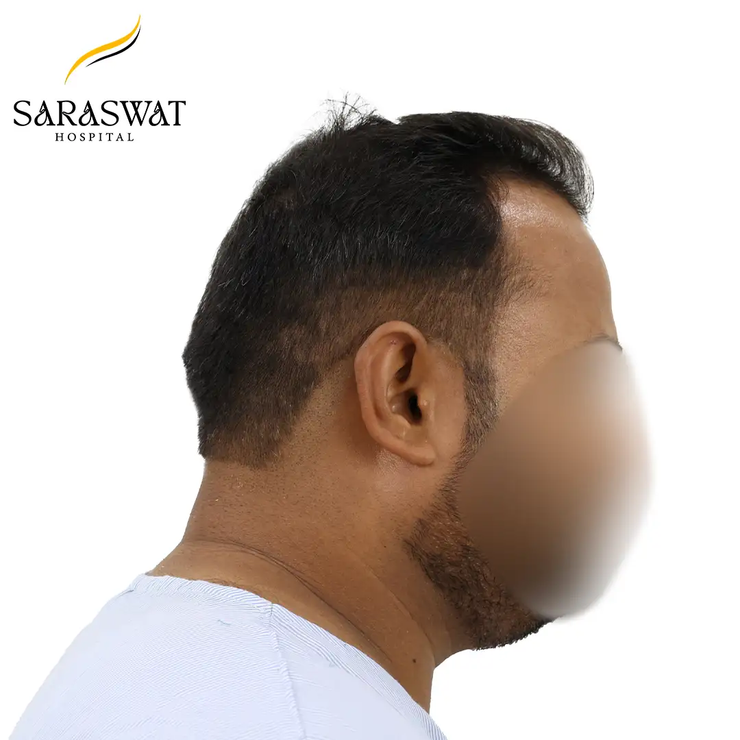 Hair Transplant Before and After