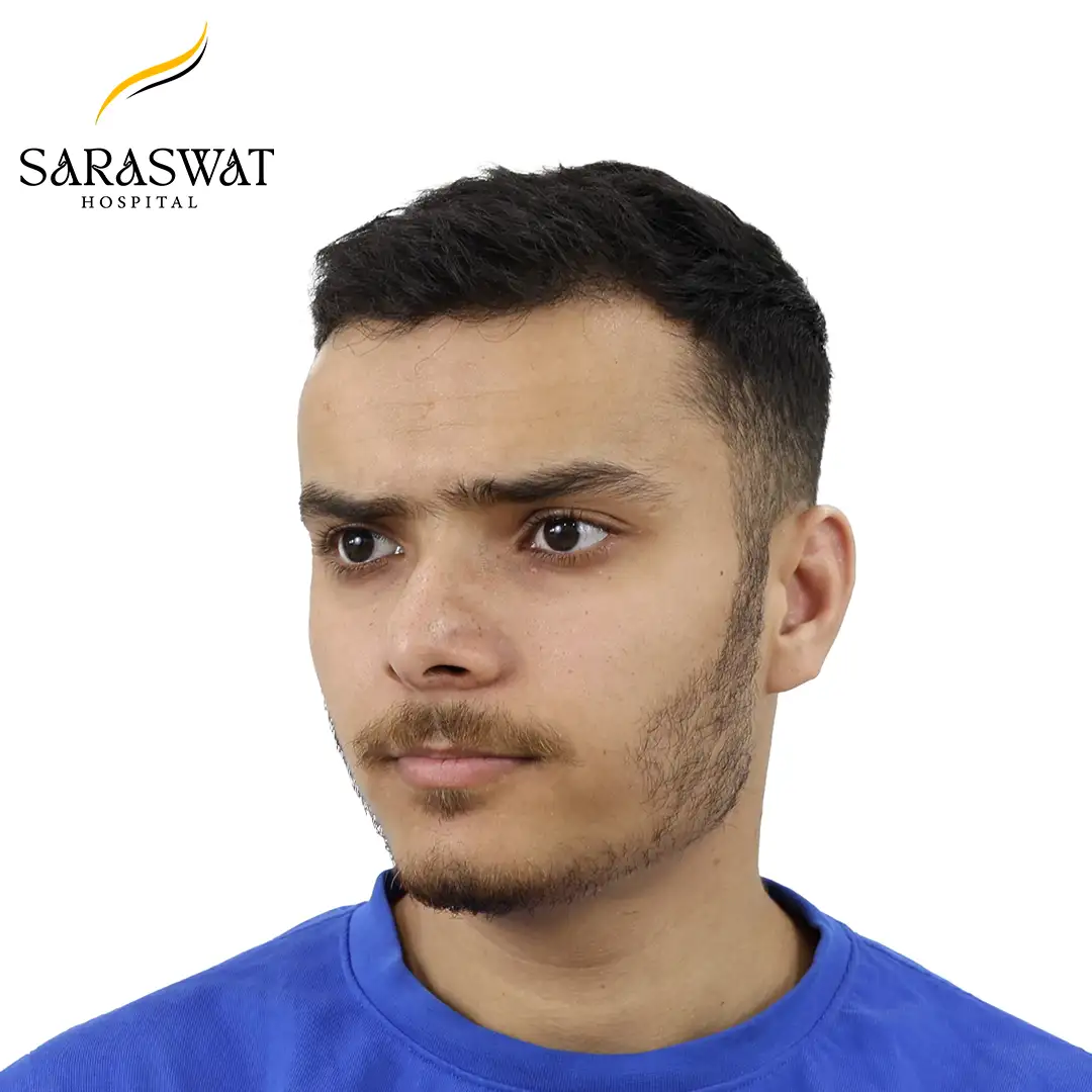 45 Degree Left FUE Hair Transplant Result After Procedure