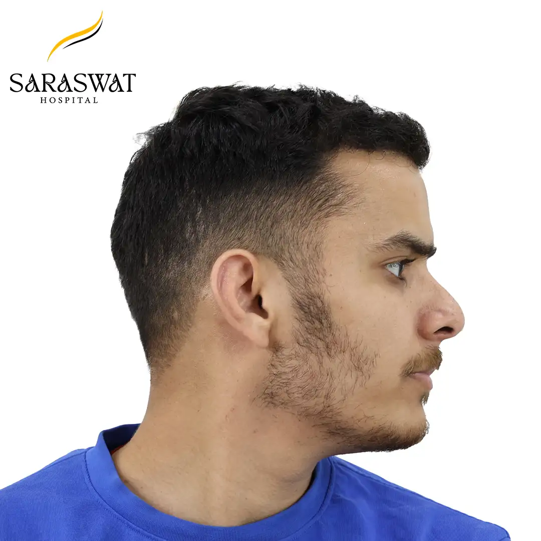 90 Degree Right FUE Hair Transplant Result After Procedure