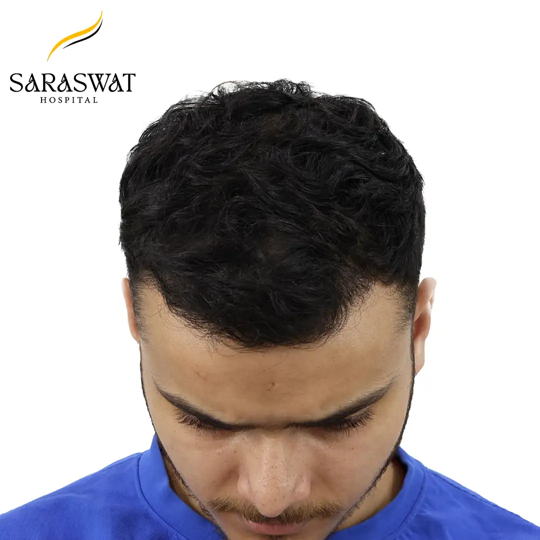 Top FUE Hair Transplant Result After Procedure