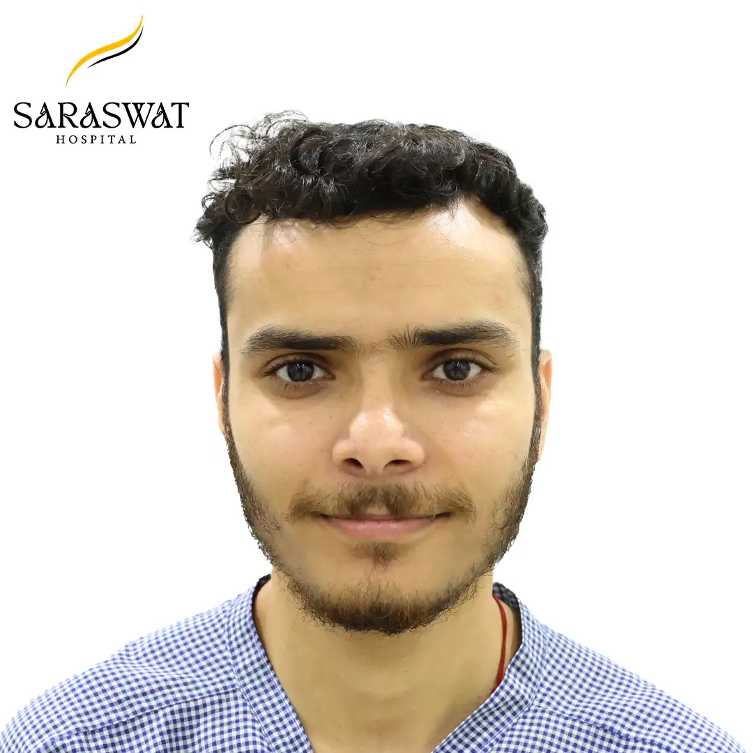 Front FUE Hair Transplant Result Before Procedure