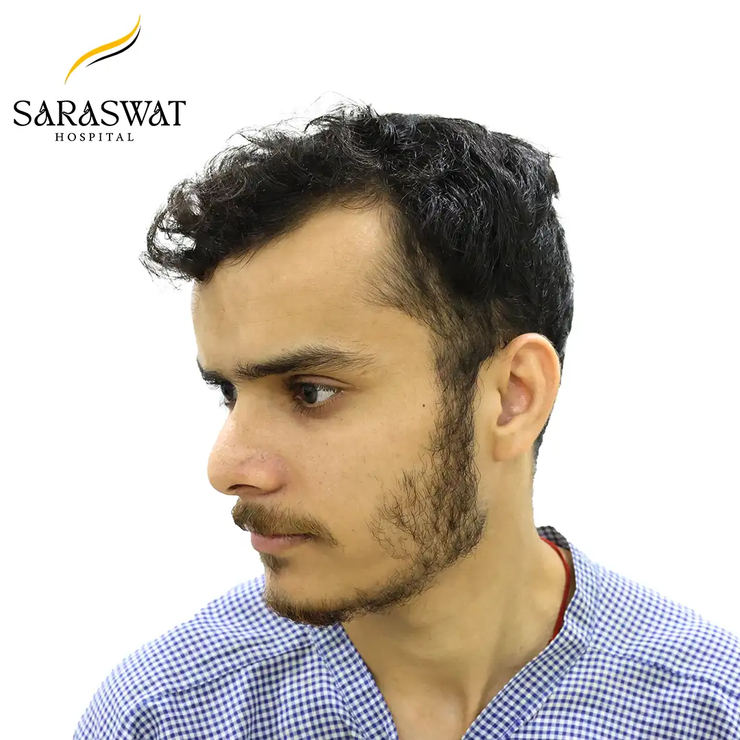 45 Degree Left FUE Hair Transplant Result Before Procedure