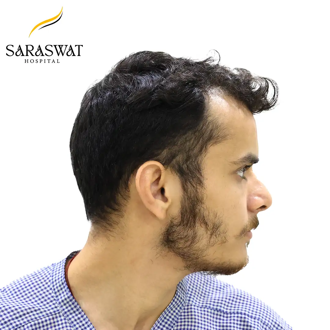 90 Degree Right FUE Hair Transplant Result Before Procedure