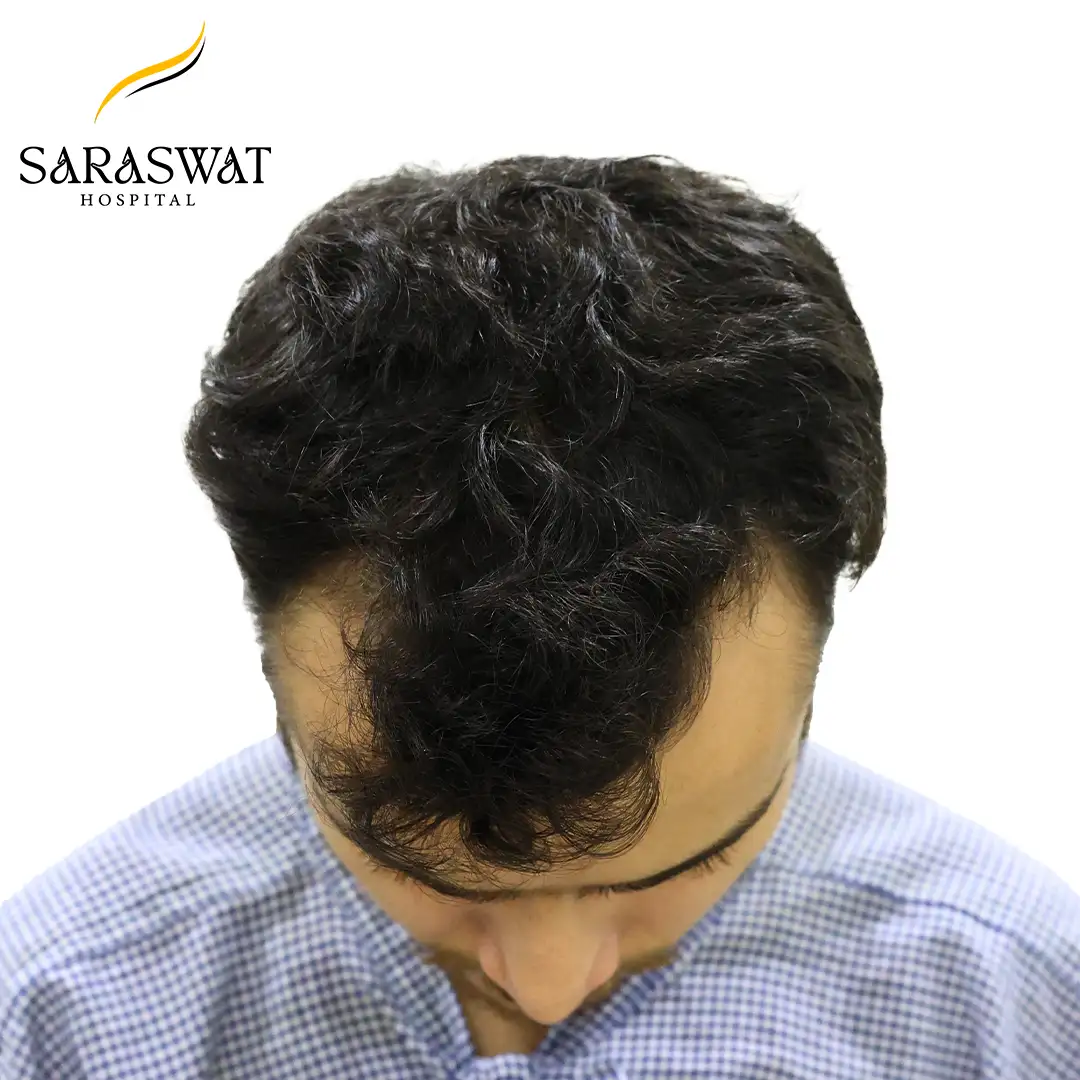 Top FUE Hair Transplant Result Before Procedure