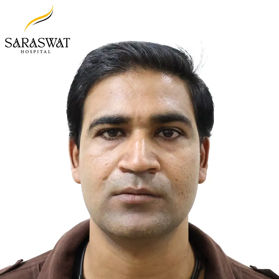 Front FUE Hair Transplant Result After Procedure