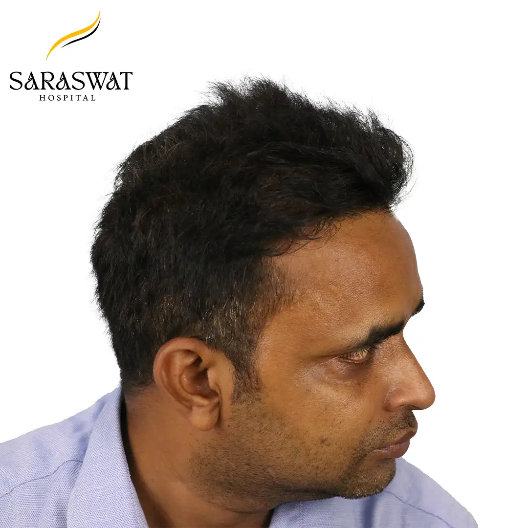 90 Degree Right FUE Hair Transplant Result After Procedure