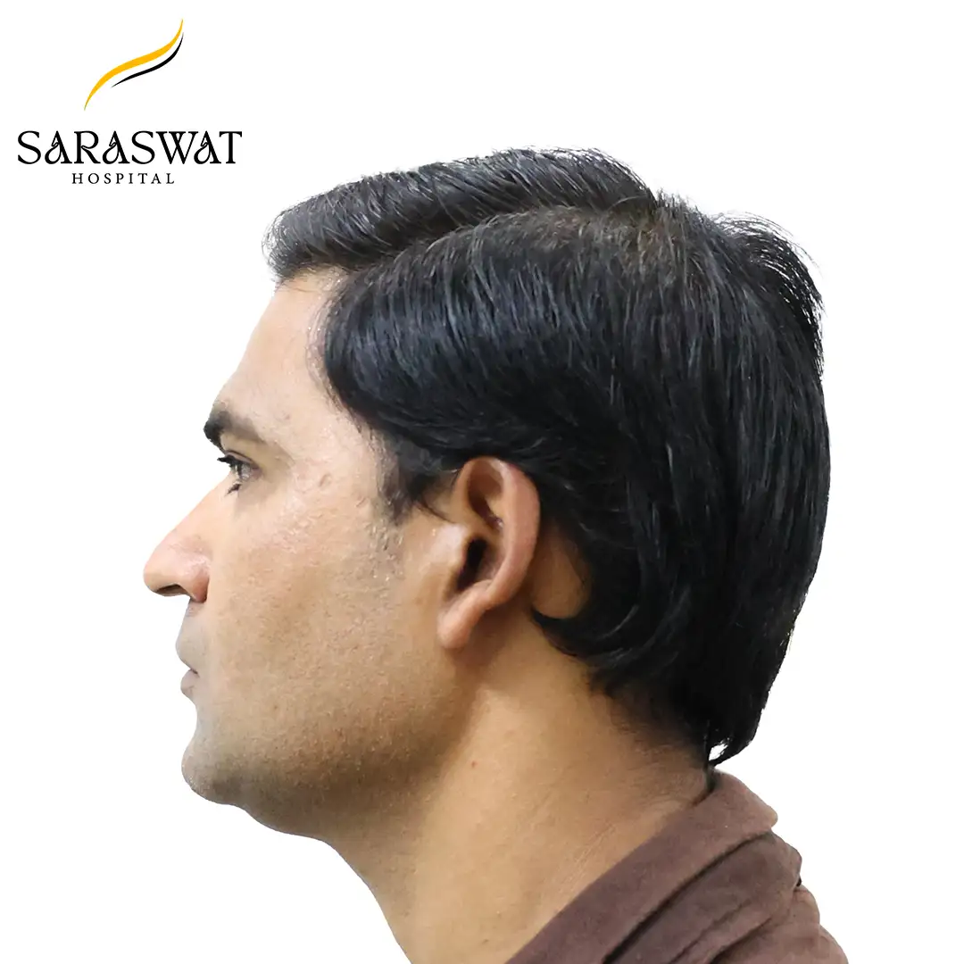 Hair Transplant Before and After Results