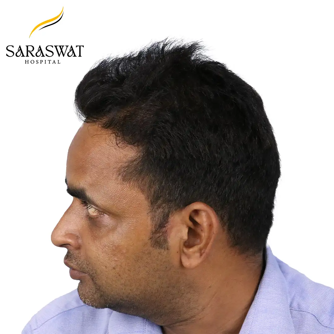 90 Degree Left FUE Hair Transplant Result After Procedure