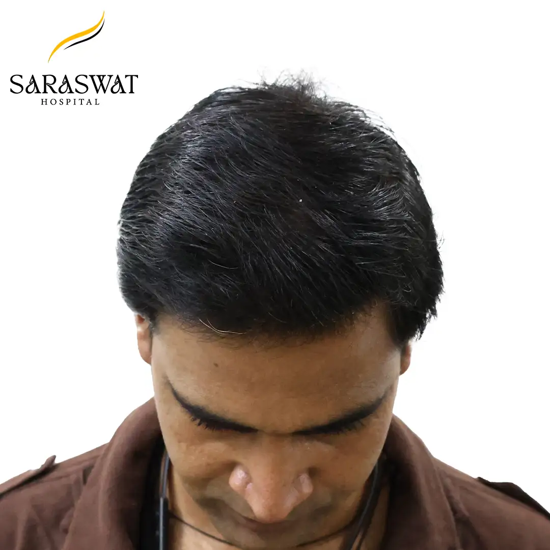 Top FUE Hair Transplant Result After Procedure