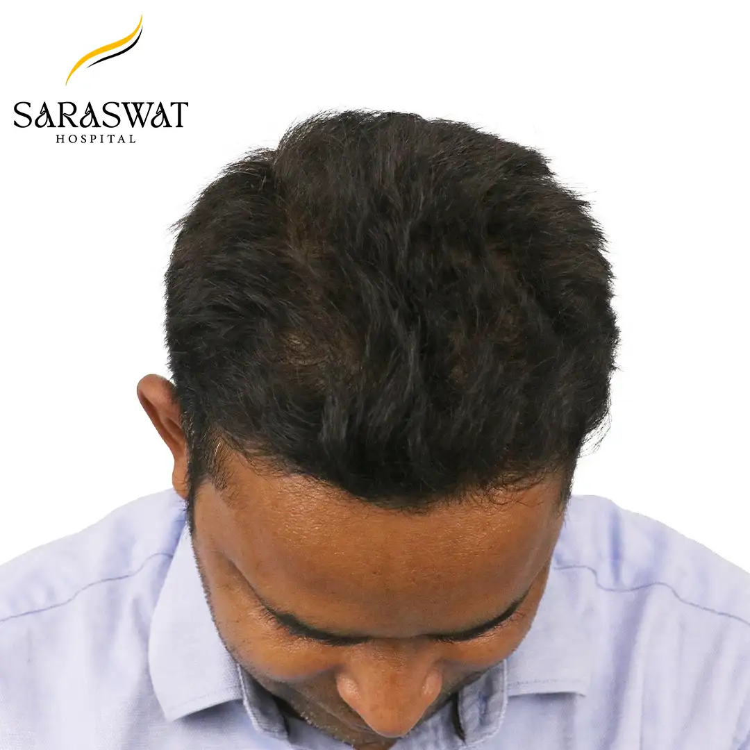 Top FUE Hair Transplant Result After Procedure