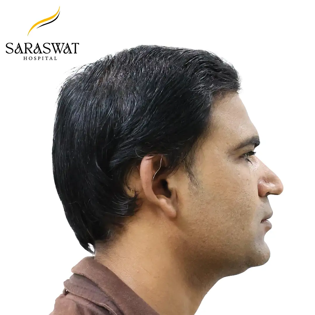 Hair Transplant Before and After Results